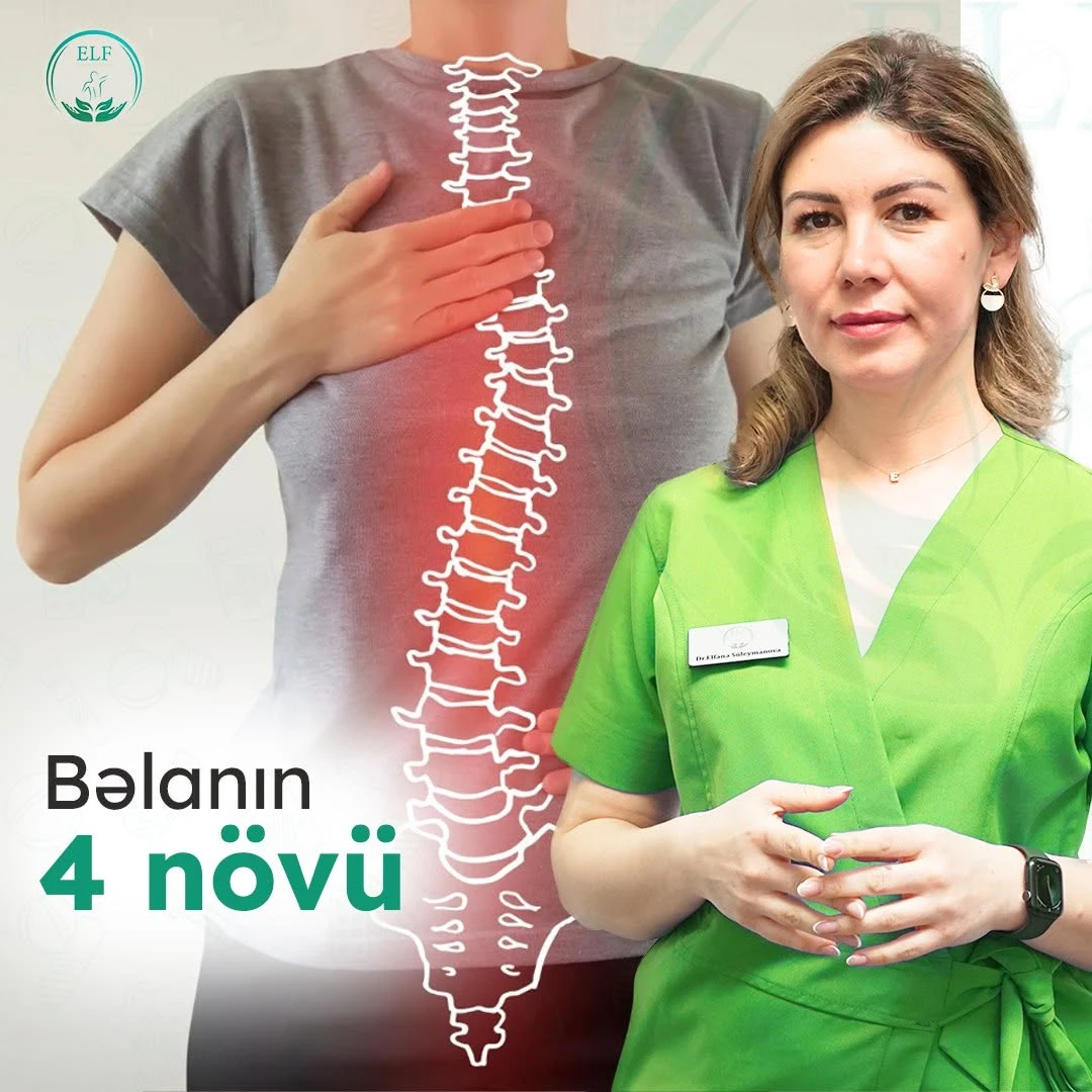 Dr. Elfanə Süleymanova və onurğa sxemi — skoliozun 4 əsas növü posteri
